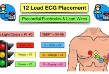 leads on ecg